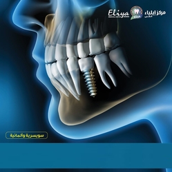 Dental Iplant
