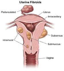 Uterine Fibroid Treatment in Manhattan Beach from PROFESSIONAL GYNECOLOGICAL SERVICES (MANHATTAN BEACH)