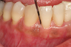 Periodontal Gum Pockets Treatment in NYC from MANHATTAN PERIODONTICS & IMPLANT DENTISTRY