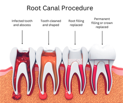 Root Canal Therapy in Bushwick, Brooklyn from BROADWAY FAMILY DENTAL