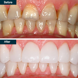 Yonkers Dental Crowns from PARK AVENUE SMILES