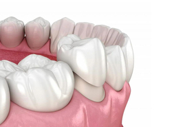 Porcelain and Zirconia Dental Crowns NYC from SHALMAN DENTISTRY