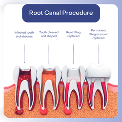 Root Canal Therapy in Hackensack, NJ from MY NEW JERSEY DENTIST