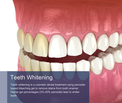 Teeth Whitening in NYC from CENTURY DENTISTRY CENTER