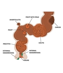 Rectal Bleeding Treatment NYC from MANHATTAN GASTROENTEROLOGY (UNION SQUARE)