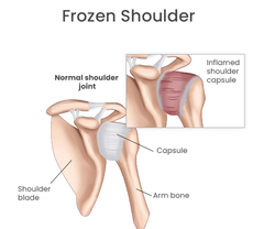 Frozen Shoulder Treatment from THE SPINE & REHAB GROUP