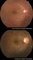 Diabetic Retinopathy from VITREOUS RETINA MACULA CONSULTANTS OF NEW YORK