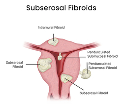 Fibroid Pain Relief in Downtown Brooklyn from DOWNTOWN VEIN TREATMENT CENTER