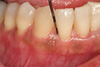 Periodontal Gum Pockets Treatment in NYC