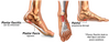 Plantar Fasciitis Surgery in NYC