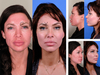 Rhinoplasty (Nose Surgery/Nose Job) in NYC ...