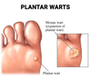 Plantar Wart Treatment in Wayne, NJ