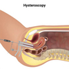 Hysteroscopy Procedure
