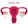 Polycystic Ovary Syndrome Treatment